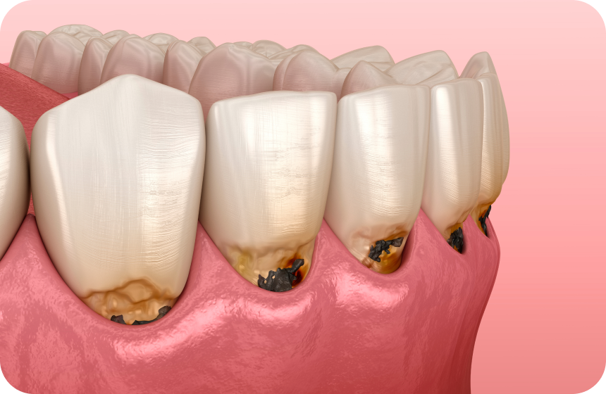 Parodontite : avis de dentiste, causes et traitements  Dentiste à Toulouse, Dentiste Mathieu Benichou