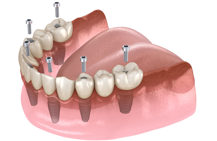 All-on-6 : la technique à 6 implants Dentiste à Toulouse, Dentiste Mathieu Benichou