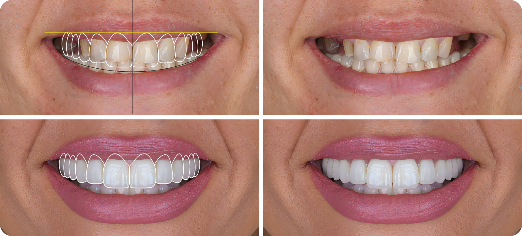 Facette dentaire Toulouse : retrouvez de belles dents et un beau sourire ! Dentiste à Toulouse, Dentiste Mathieu Benichou