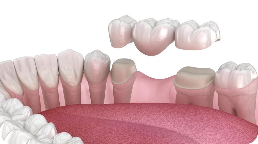 Bridge dentaire Toulouse Dentiste à Toulouse, Dentiste Mathieu Benichou
