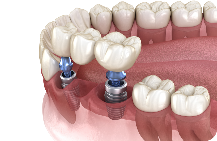 Bridge et implant dentaire : quelle est la différence ? Dentiste à Toulouse, Dentiste Mathieu Benichou