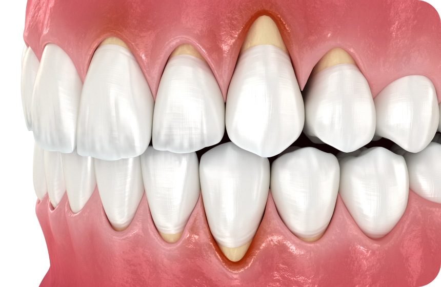 Récession gingivale : tout savoir Dentiste à Toulouse, Dentiste Mathieu Benichou