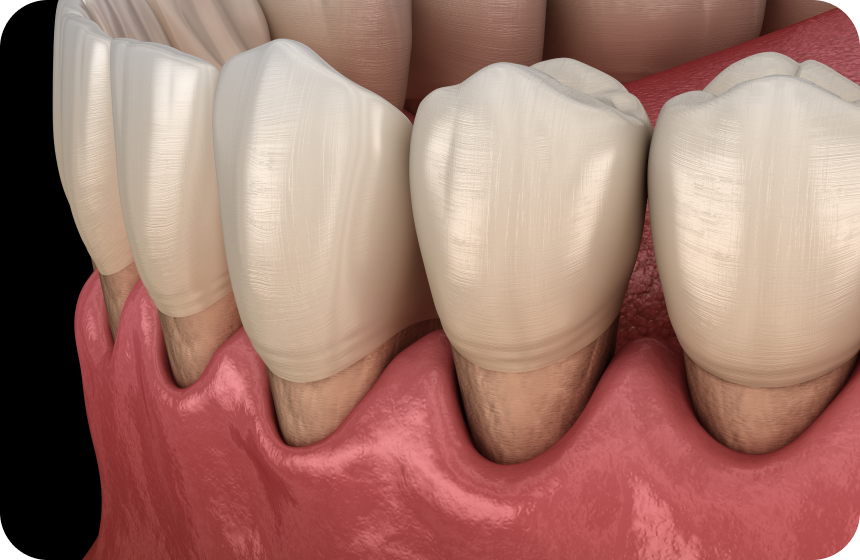 Déchaussement des dents : comment l’éviter et le traiter ? Dentiste à Toulouse, Dentiste Mathieu Benichou