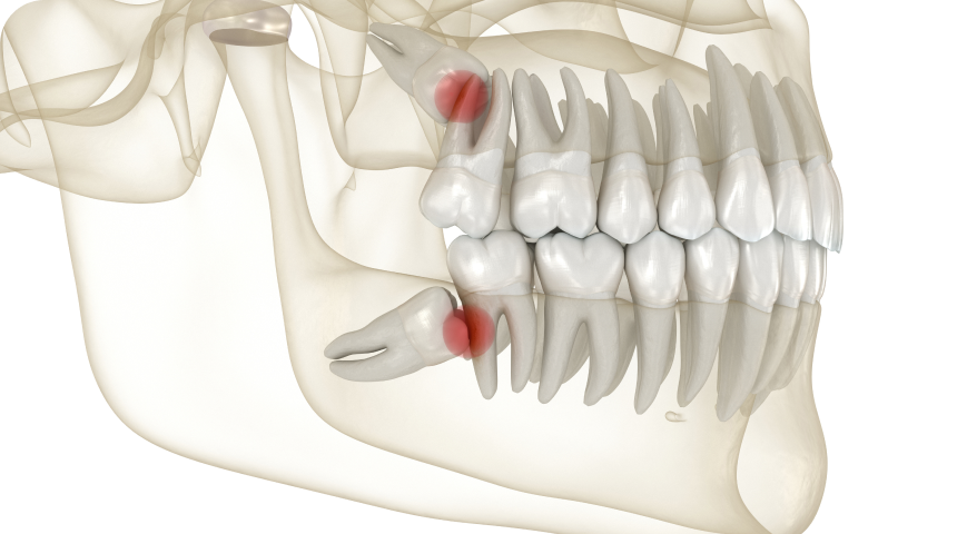 Chirurgie et dents de sagesse à Toulouse Dentiste à Toulouse, Dentiste Mathieu Benichou