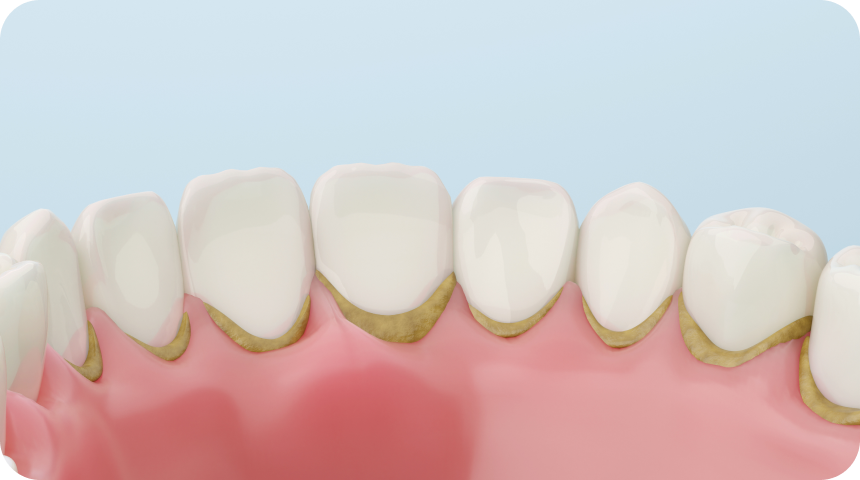 Détartrage et polissage à Toulouse Dentiste à Toulouse, Dentiste Mathieu Benichou