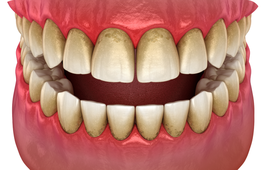 Parodontite : avis de dentiste, causes et traitements  Dentiste à Toulouse, Dentiste Mathieu Benichou