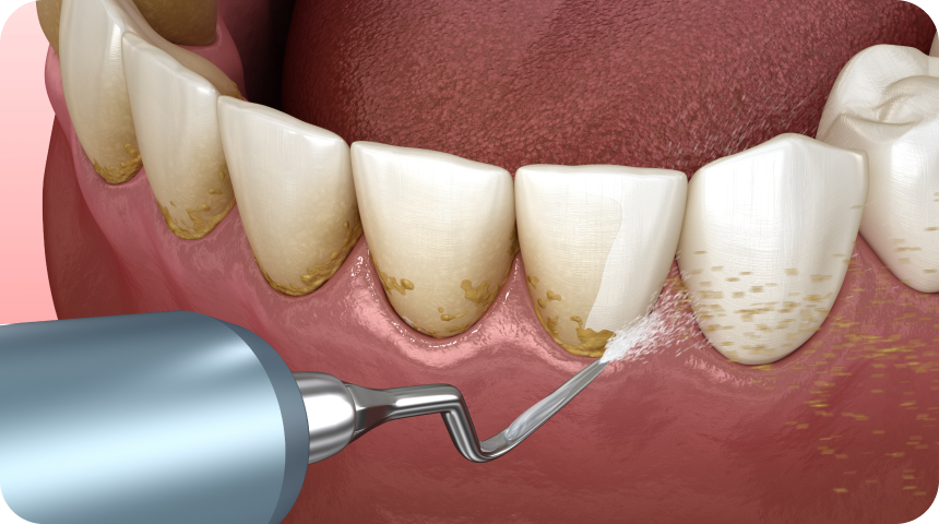 Détartrage et polissage à Toulouse Dentiste à Toulouse, Dentiste Mathieu Benichou