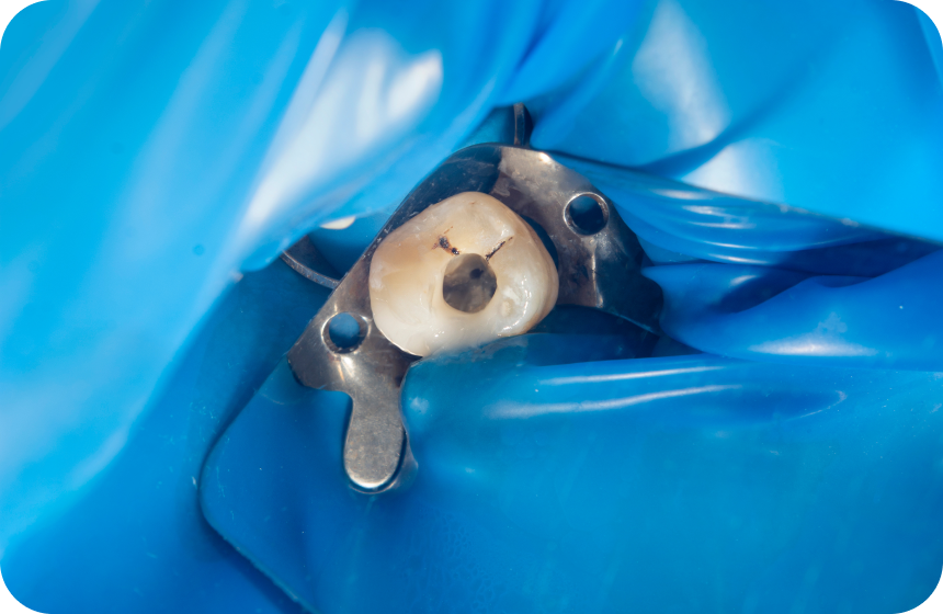 Le traitement canalaire sous digue Dentiste à Toulouse, Dentiste Mathieu Benichou