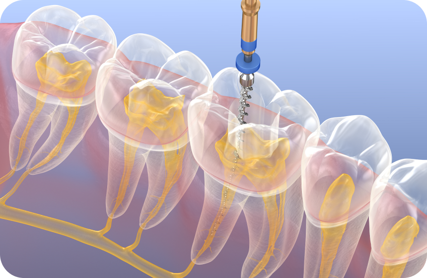 Tout ce que vous devez savoir sur le retraitement endodontique Dentiste à Toulouse, Dentiste Mathieu Benichou