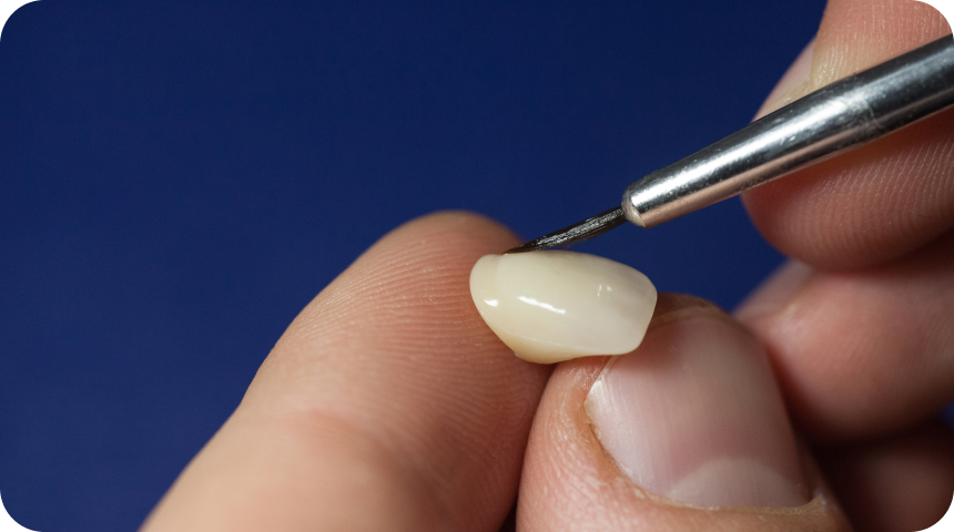 Facette dentaire Toulouse : retrouvez de belles dents et un beau sourire ! Dentiste à Toulouse, Dentiste Mathieu Benichou