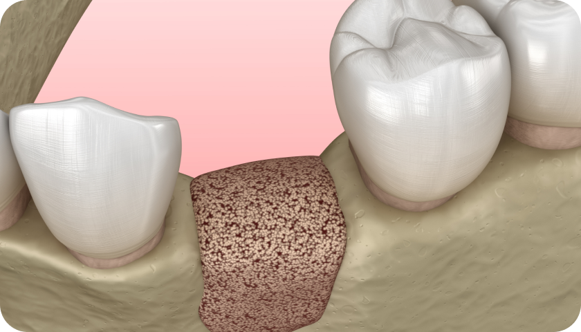 Greffe osseuse dentaire à Toulouse Dentiste à Toulouse, Dentiste Mathieu Benichou