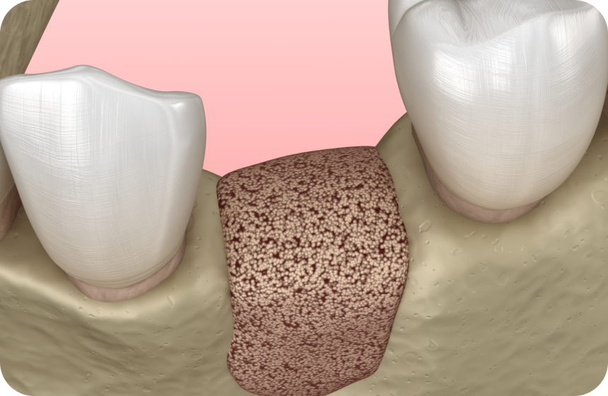 Régénération osseuse guidée : explication de dentiste Dentiste à Toulouse, Dentiste Mathieu Benichou