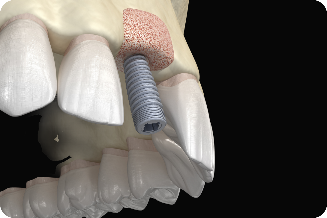 Greffe osseuse dentaire à Toulouse Dentiste à Toulouse, Dentiste Mathieu Benichou