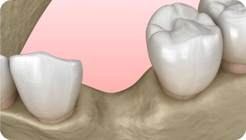 Greffe osseuse dentaire à Toulouse Dentiste à Toulouse, Dentiste Mathieu Benichou