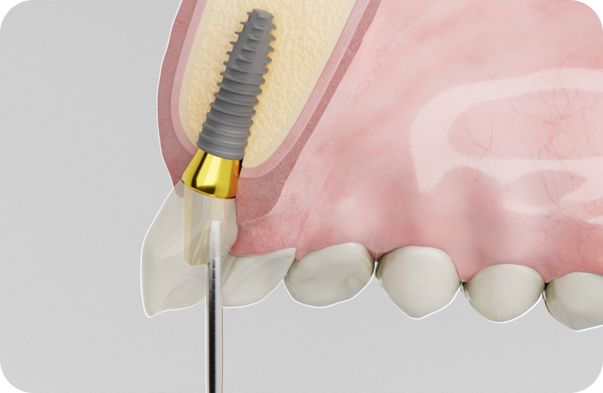 Implant dentaire : notre guide Dentiste à Toulouse, Dentiste Mathieu Benichou