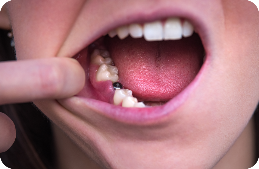 Délai entre une extraction dentaire et la pose d’un implant ? Dentiste à Toulouse, Dentiste Mathieu Benichou