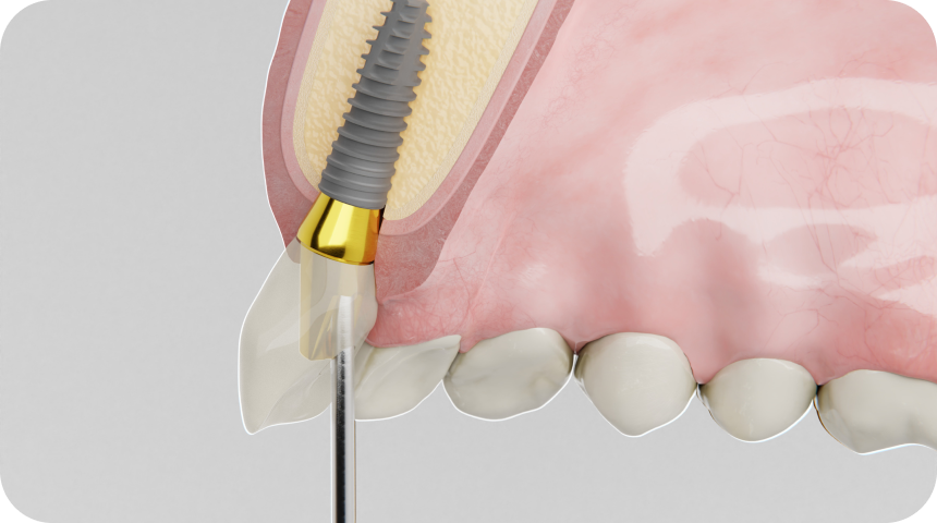 implant dentaire solution durable sourire Couronne dentaire à Toulouse Dentiste à Toulouse, Dentiste Mathieu Benichou
