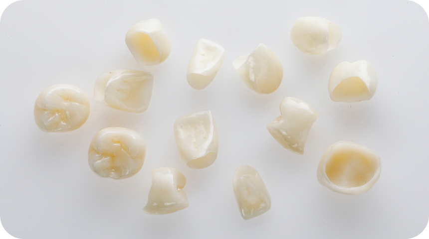 implant dentaire stabilite confort masticatoire Couronne dentaire à Toulouse Dentiste à Toulouse, Dentiste Mathieu Benichou