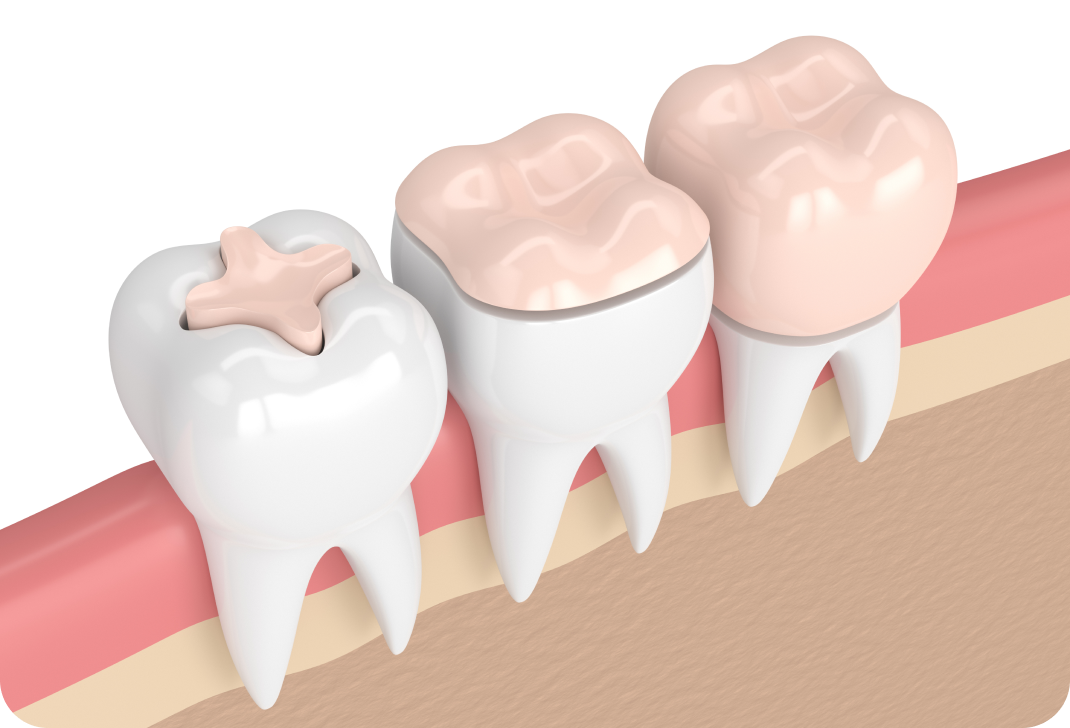 Prothèses fixe, Inlay-Onlay à Toulouse Dentiste à Toulouse, Dentiste Mathieu Benichou