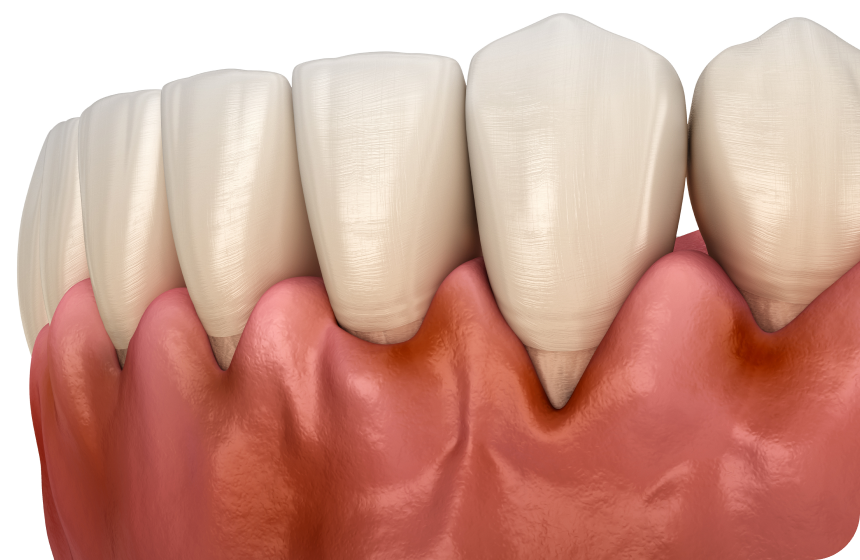 Maladie parodontale : causes, symptômes et traitements ! Dentiste à Toulouse, Dentiste Mathieu Benichou