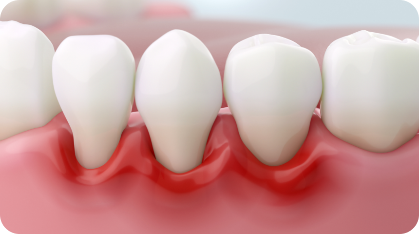 Parodontologie à Toulouse Dentiste à Toulouse, Dentiste Mathieu Benichou