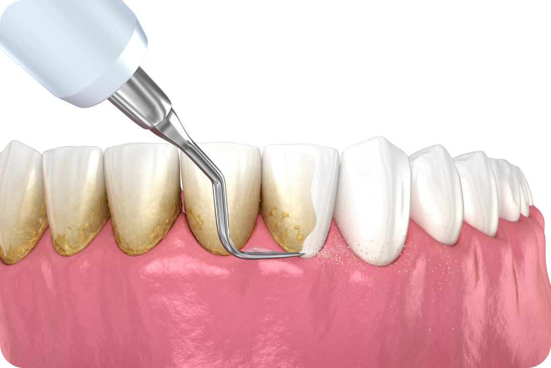 Détartrage et polissage à Toulouse Dentiste à Toulouse, Dentiste Mathieu Benichou