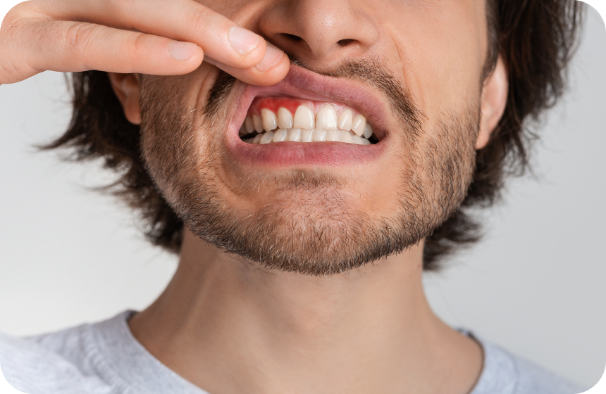 La gingivite Dentiste à Toulouse, Dentiste Mathieu Benichou